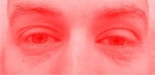 Dermatitis palpebral: dermatitis en los párpados